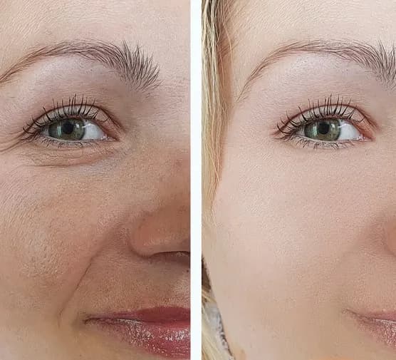 Jak często robić mikrodermabrazję w domu, aby uniknąć podrażnień?