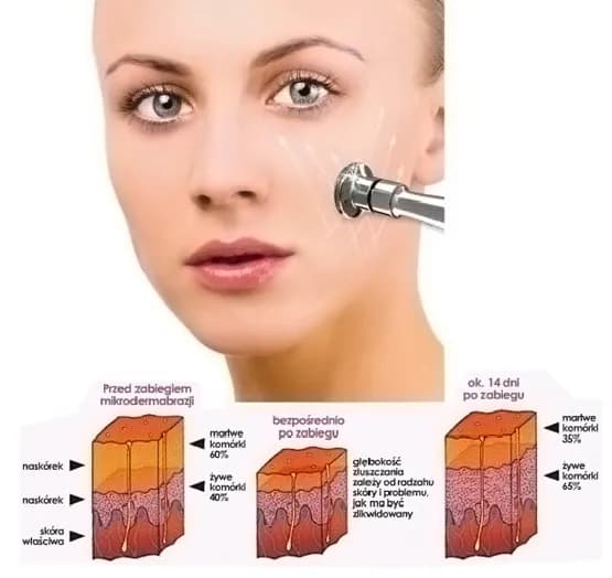 Jak wygląda twarz po mikrodermabrazji? Efekty i zmiany w skórze