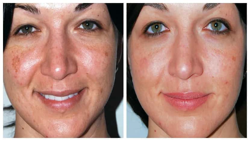 Mikrodermabrazja co ile powtarzać, by uniknąć utraty efektów?