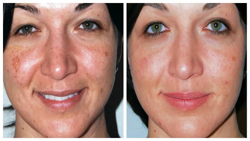 Mikrodermabrazja co ile powtarzać, by uniknąć utraty efektów?